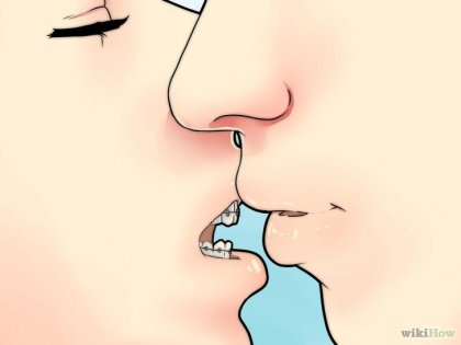 Як цілуватися з брекетами 1