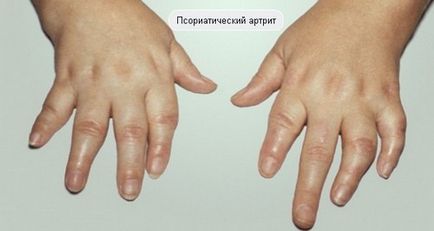 Cum apare psoriazisul pe mâinile fotografiei fazei inițiale și cum se tratează aceasta
