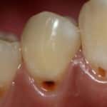 A fogszuvasodás fotó - mi a fogszuvasodás és hogy néz ki