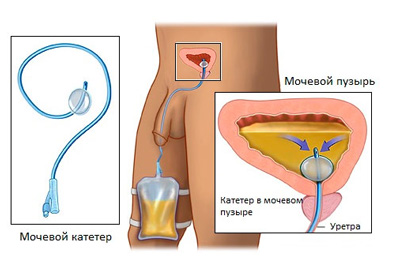 Cateterizarea recomandărilor și contraindicațiilor vezicii urinare