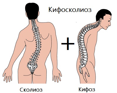 Kifoskolioza coloanei vertebrale - cauze, grade, tratament