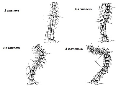 Kifoskolioza coloanei vertebrale - cauze, grade, tratament