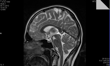 agyi ciszta a magzatban funkciók, diagnózis, kezelés, modern klinikán kezelés