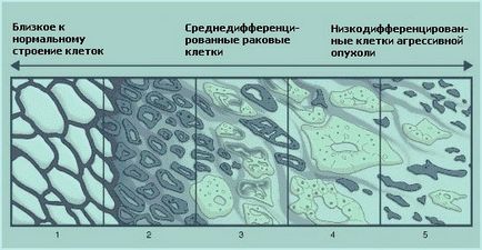 Класифікація раку простати - шкала Глісон при раку передміхурової залози