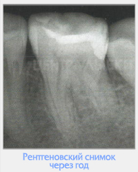 Utilizarea clinică a cimentului MTA în practica endodontică