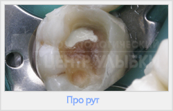 Utilizarea clinică a cimentului MTA în practica endodontică