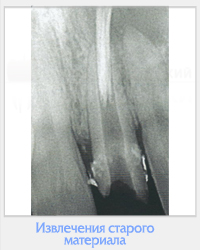 Utilizarea clinică a cimentului MTA în practica endodontică