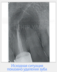 Utilizarea clinică a cimentului MTA în practica endodontică