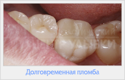 Utilizarea clinică a cimentului MTA în practica endodontică