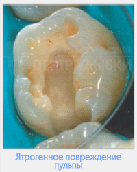 Utilizarea clinică a cimentului MTA în practica endodontică