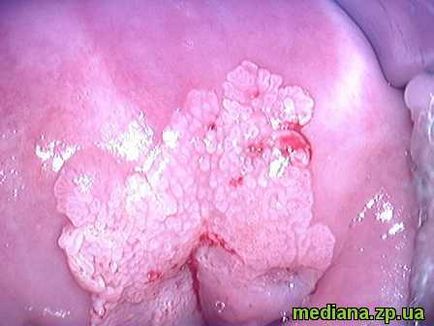 Condylomata pe colul uterin 1
