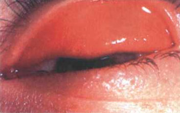 Ochii roșii, genele și pleoapele se îmbină cu conjunctivita infecțioasă