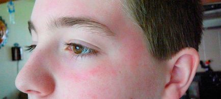 Vörös foltok a szem alatt - valamennyi okát és hatékony kezelése