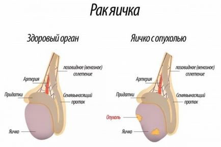 Cryptorchidism (testicul nedescendent) - cauze, simptome, diagnostic și tratament