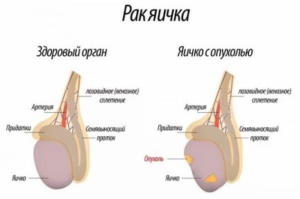 Крипторхізм (неопущення яєчка) - причини, симптоми, діагностика та лікування