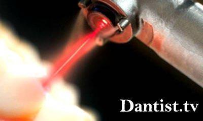 Laser preț de extracție dinte, vederi și fotografii