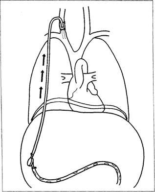 Terápiás paracentesissel ascites (hasvízkór) Terápiás paracentesissel ascites
