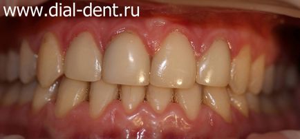 Tratamentul laser al gingiilor cu gingivită