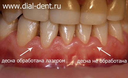 Лікування ясен лазером при гінгівіті