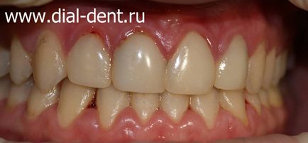 Tratamentul laser al gingiilor cu gingivită