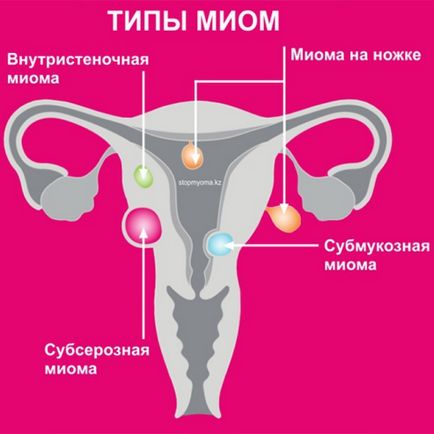 Tratamentul fibromilor uterini la Samara