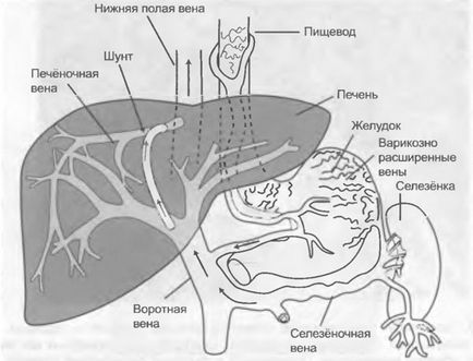 Лікування портальної гіпертензії