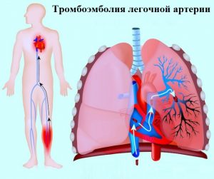 Легенева тромбоемболія лікування народними засобами можливо