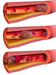 Tratamentul cu tromboembolism pulmonar cu remedii folclorice este posibil