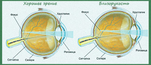 Хибна короткозорість у дітей і дорослих симптоми і лікування