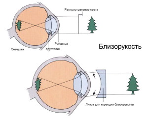 Hamis myopia gyermekek és felnőttek, tünetei és kezelése