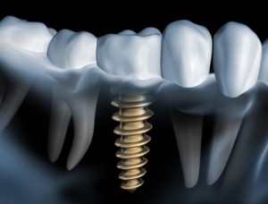 Mituri despre implanturile dentare, blog clinic dentaprime