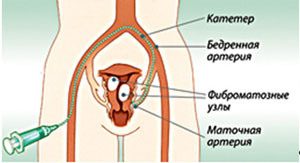 Myoma nu este un verdict, revista cosmopolită