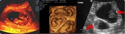 Багатоплідна вагітність як особливість зачаття (відео)
