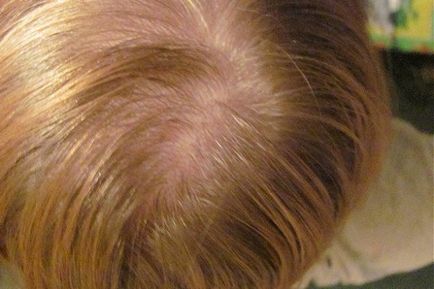 Este posibil să se vindece complet alopecia androgenică sau este nerealistă?