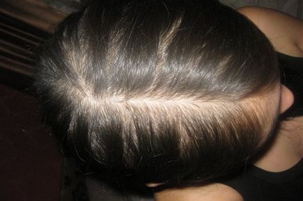 Este posibil să se vindece complet alopecia androgenică sau este nerealistă?