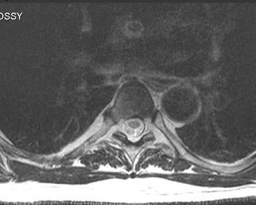 Mrt expert, mrt la un sindrom dureros în spate (mrt un departament toracal al unei coloane vertebrale)