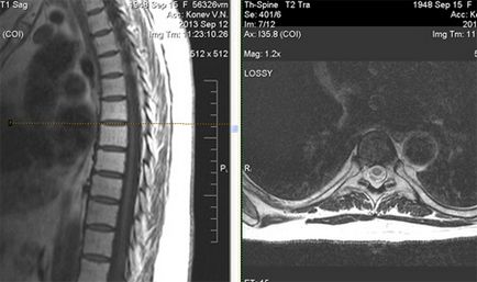 Mrt expert, mrt la un sindrom dureros în spate (mrt un departament toracal al unei coloane vertebrale)