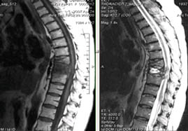 Mrt expert, mrt la un sindrom dureros în spate (mrt un departament toracal al unei coloane vertebrale)