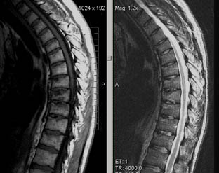 Mrt expert, mrt la un sindrom dureros în spate (mrt un departament toracal al unei coloane vertebrale)