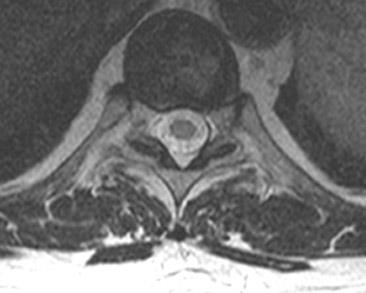 Mrt expert, mrt la un sindrom dureros în spate (mrt un departament toracal al unei coloane vertebrale)