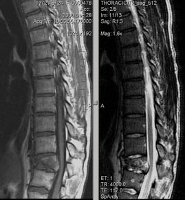 Mrt expert, mrt la un sindrom dureros în spate (mrt un departament toracal al unei coloane vertebrale)