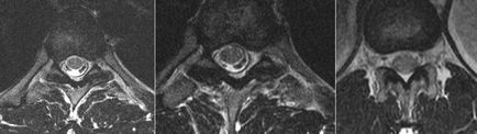 Mrt expert, mrt la un sindrom dureros în spate (mrt un departament toracal al unei coloane vertebrale)