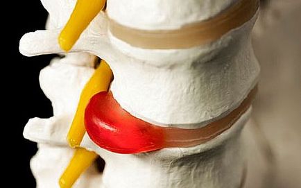 Metode populare de tratare a herniei unui coloană vertebrală în condiții de casă