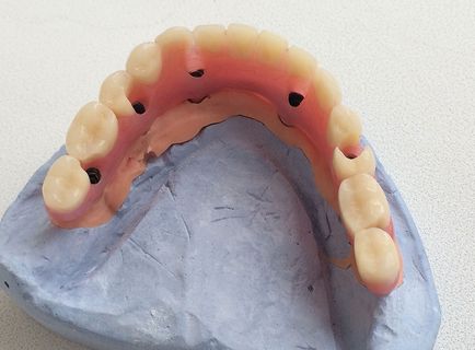 Nem fogak teljes és részleges fogsorok - megtudja, mi a legjobb! (Dental) Nem fogak teljes és részleges fogsorok - megtudja, mi a legjobb!