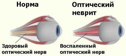 Nevrită optică - cauze, simptome și tratament