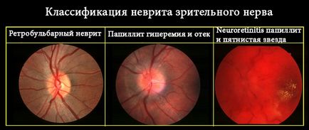 Неврит зорового нерва - причини, симптоми і лікування