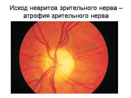 Неврит зорового нерва - причини, симптоми і лікування