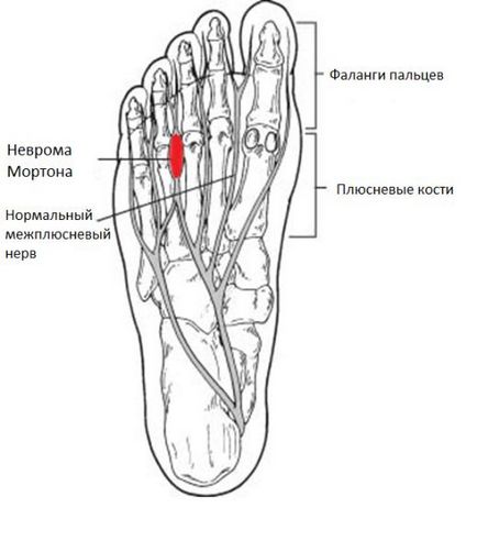 Неврома Мортона, фото до і після, операція, відгуки, лікування, реабілітація та відновлення