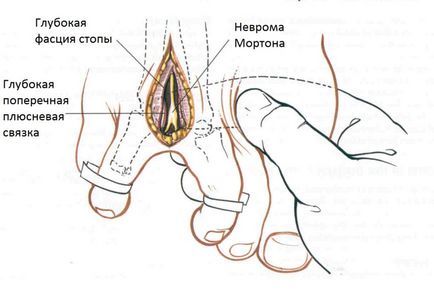 Неврома Мортона, фото до і після, операція, відгуки, лікування, реабілітація та відновлення