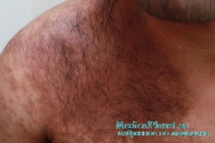 Nevus Becker - diagnostic, tratament